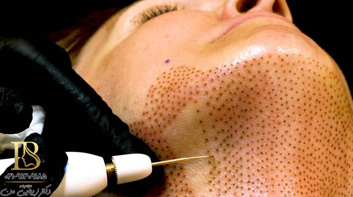 مزوتراپی غبغب در اصفهان